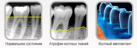 Dental bone implants