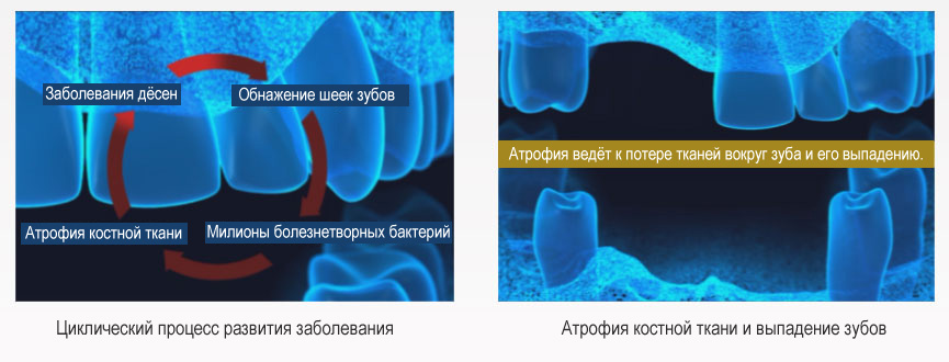 Extensive Bone and Tooth Loss